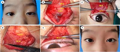 Modified conjoint fascial sheath suspension for the correction of severe congenital blepharoptosis in pediatric patients at different ages